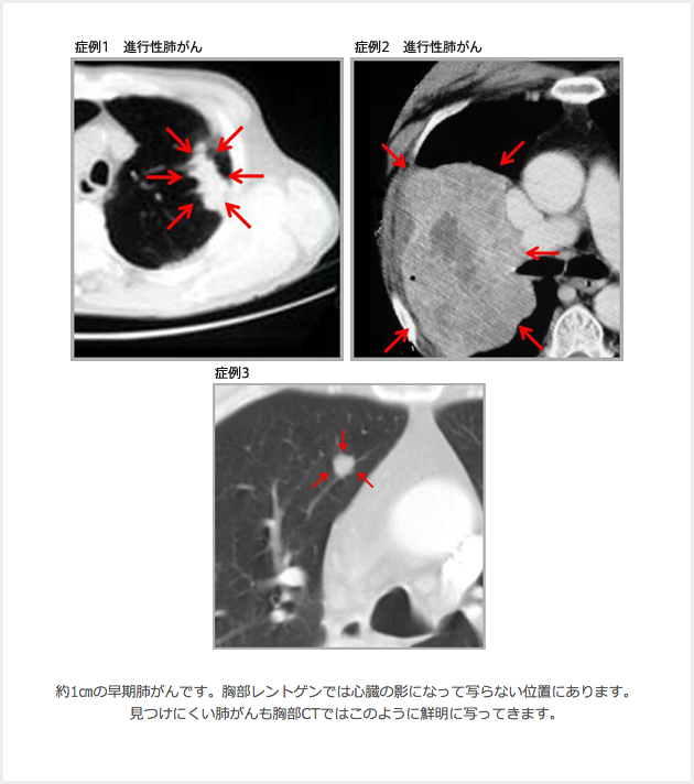 胸部CTによる肺がんの症例