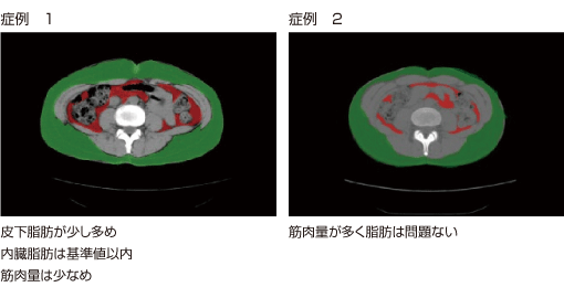 内臓脂肪CTによる内臓脂肪と皮下脂肪の測定