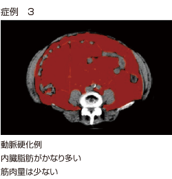 内臓脂肪CTによる動脈硬化の症例