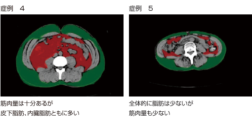 内臓脂肪CTによる筋肉量の測定