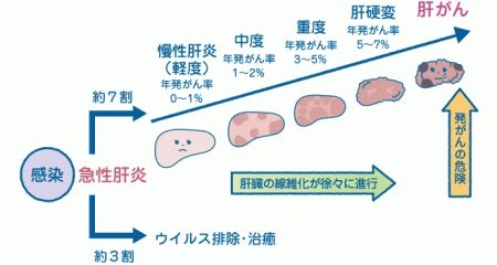 肝硬変　肝がん